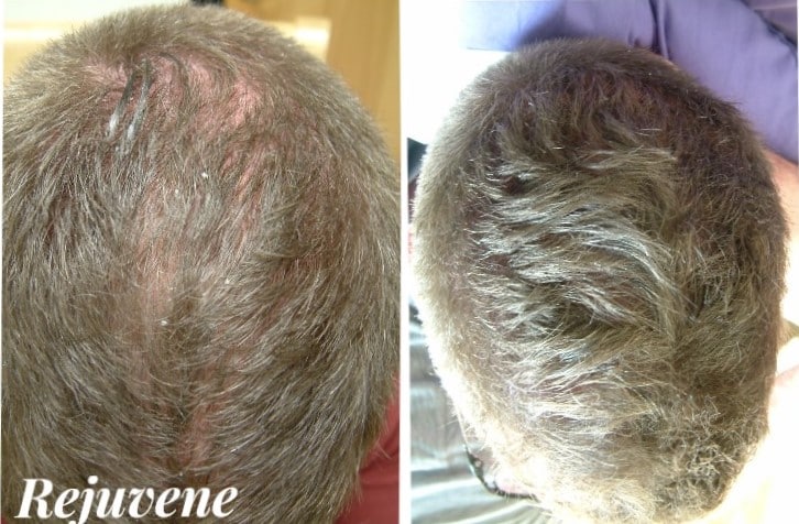 before and after Hair Regeneration Cincinnati OH