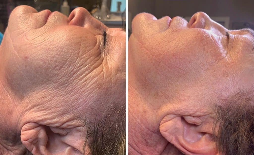 before after Microneedling Cincinnati OH