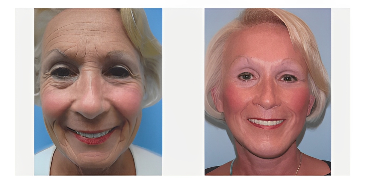 Face-Lift-