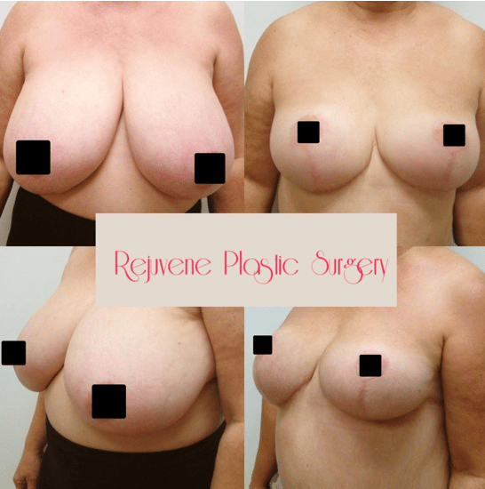 breast-reduction-3