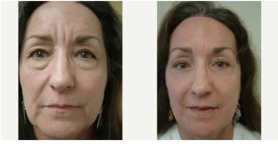 Before and After Image: Brow Lift, Upper and Lower Blepharoplasty - front