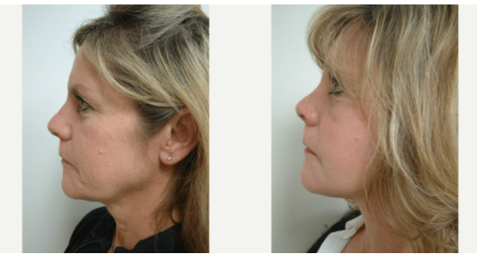 Before and After Image: Facelift and Neck Lift - left-side