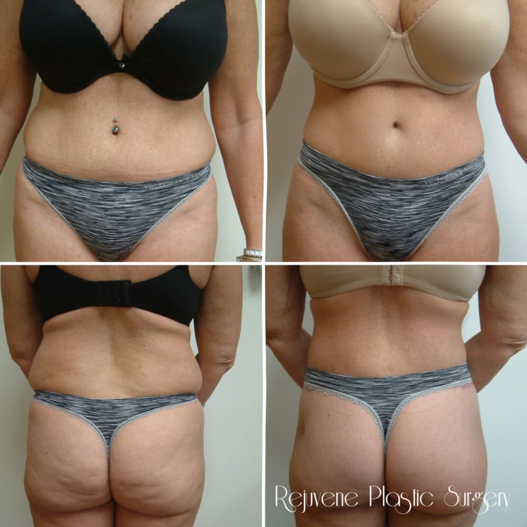 Before and After Image: Body Lift and Butt Lift - front