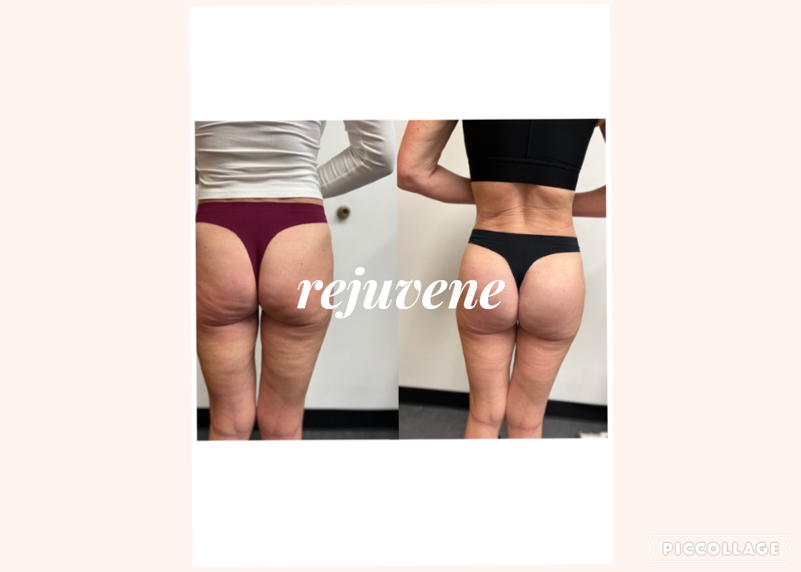 butt implant