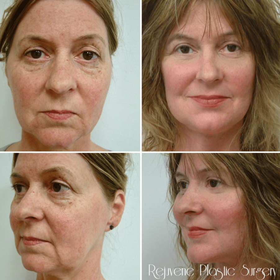 facelift and neck lift_6