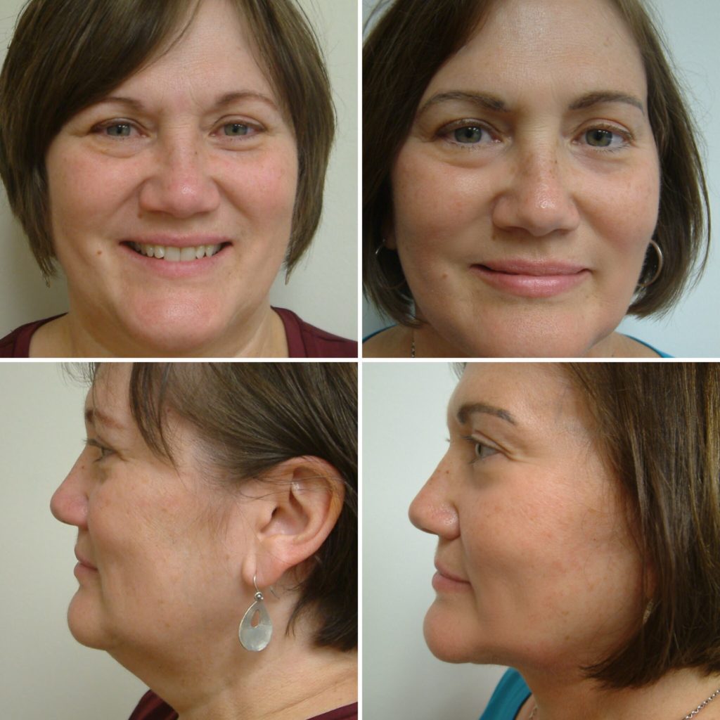 facelift and neck lift_7