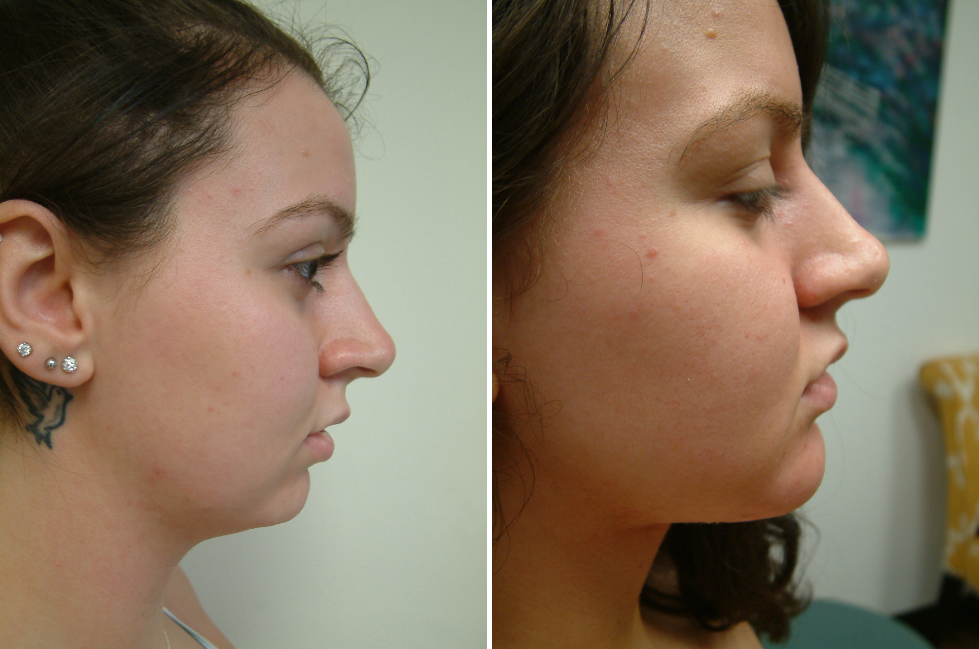 Before and After Image: Neck Lift - right-side