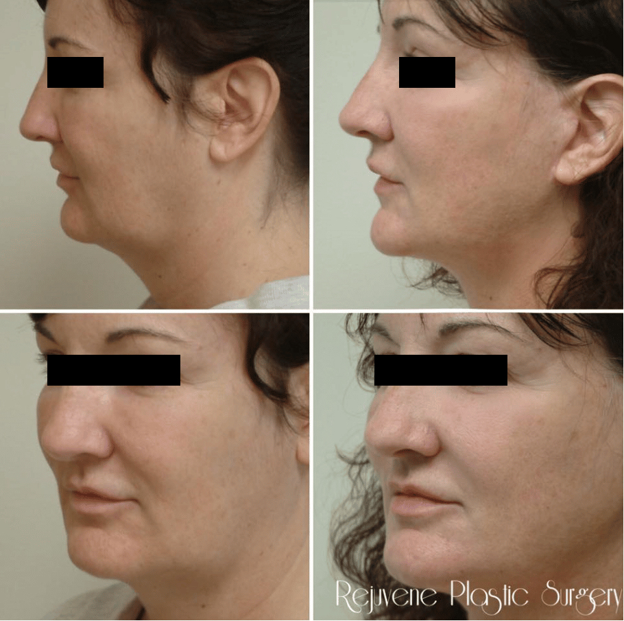 Before and After Image: Neck Lift - left-side