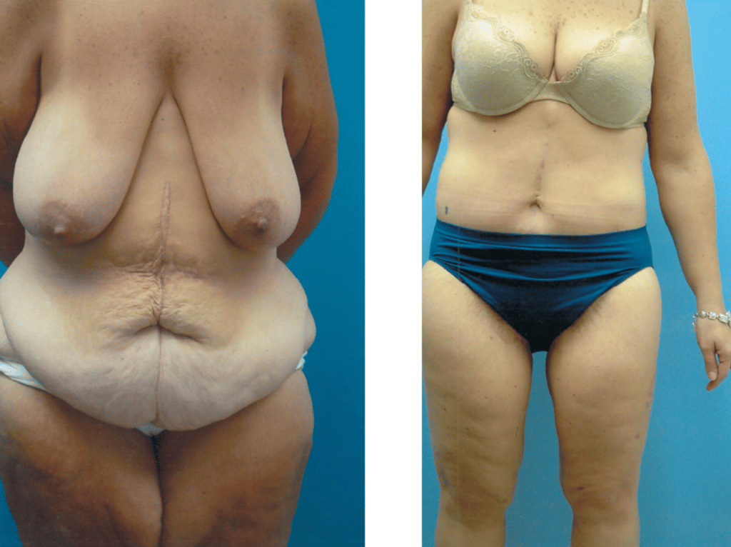 Before and After Image: Tummy Tuck and Mommy Makeover - front