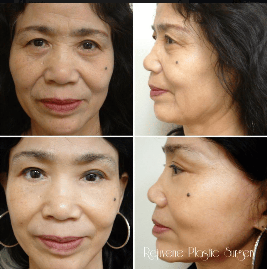 Before and After Image: Upper and Lower Blepharoplasty - front